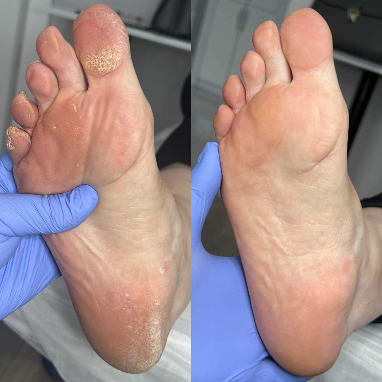 Antes e depois de cuidado com calosidades